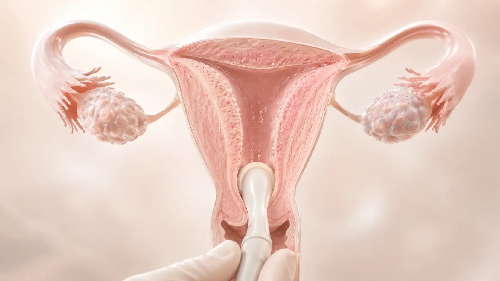 Medical illustration of the uterus and endometrial cavity being assessed before IVF treatment planning